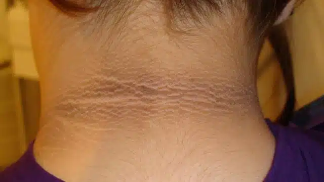 Acanthosis nigricans