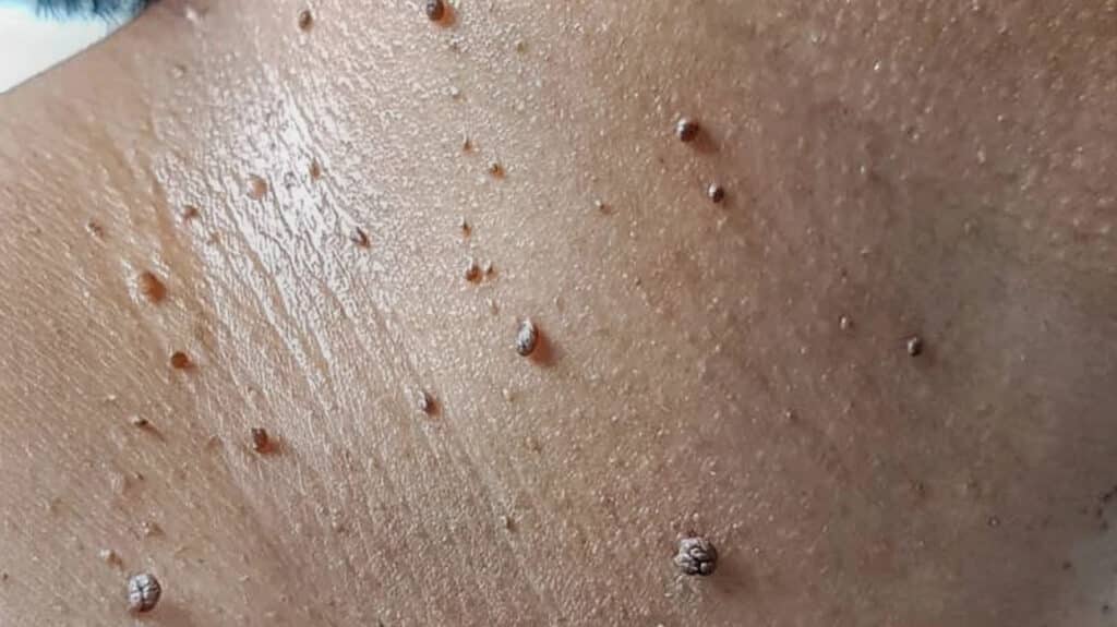 Skin tags