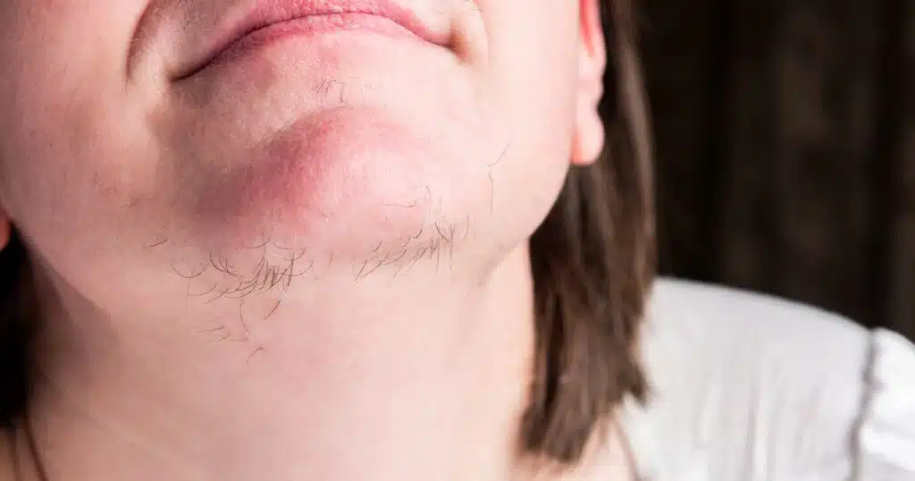 Hirsutism