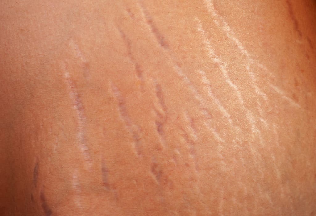 Stretch marks