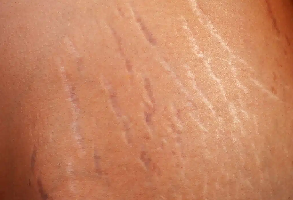 Stretch marks